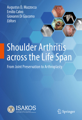 Shoulder Arthritis across the Life Span: From Joint Preservation to Arthroplasty